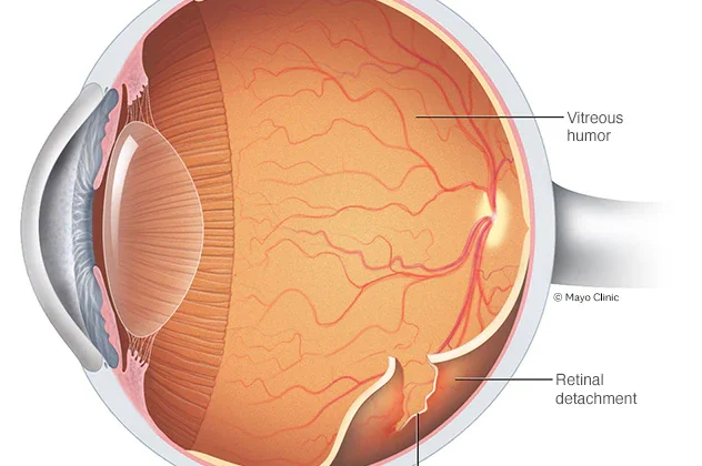 اسباب انفصال الشبكية​