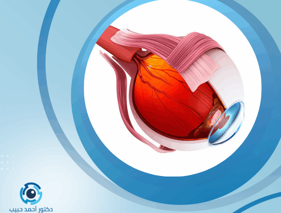 علاج ضعف شبكية العين عند الأطفال