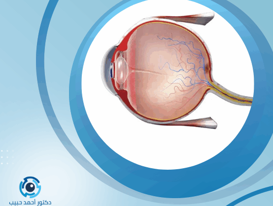 أنواع ثقب الشبكية