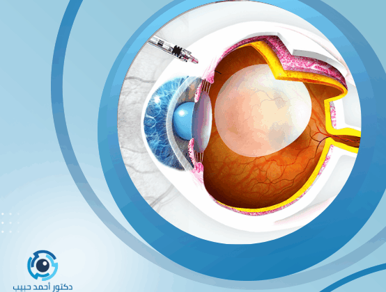 ثقب شبكية العين اليسرى