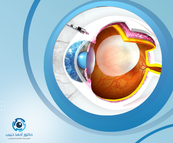 ثقب شبكية العين اليسرى
