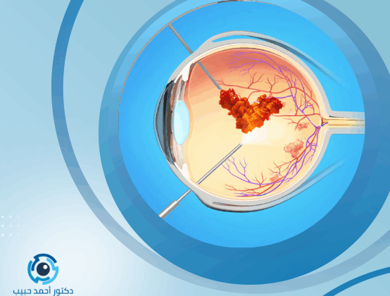 نسبة نجاح عملية شبكية العين