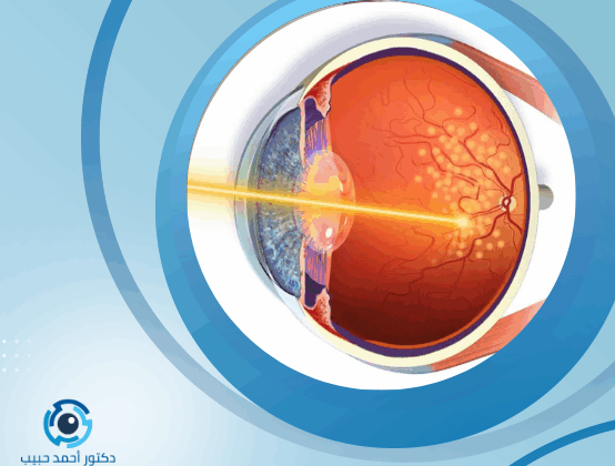 أعراض ثقب شبكية العين