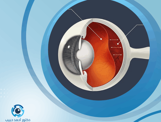 نزيف شبكية العين وعلاجه