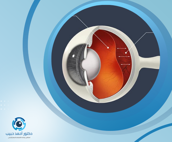 نزيف شبكية العين وعلاجه