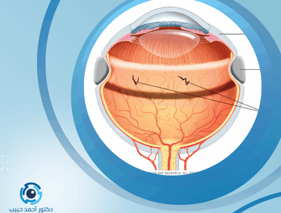 عملية انفصال شبكية العين