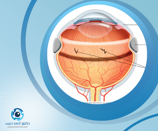 عملية انفصال شبكية العين