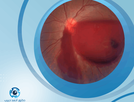 علاج نزيف شبكية العين