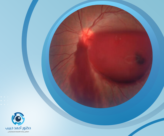 علاج نزيف شبكية العين