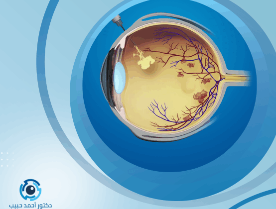 هل يوجد زرع شبكية العين