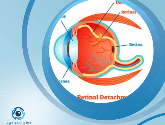 عملية الشبكية بالليزر