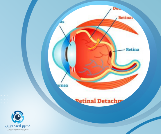 عملية الشبكية بالليزر