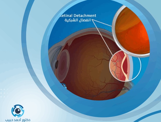 علاج ارتشاح شبكية العين