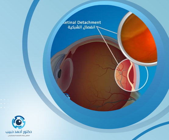 علاج ارتشاح شبكية العين