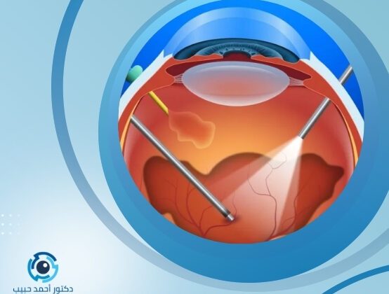 مضاعفات عملية قص السائل الزجاجي