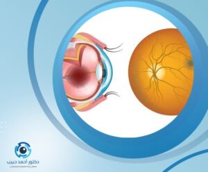 أعراض ثقب الشبكية أعراض ثقب الشبكية