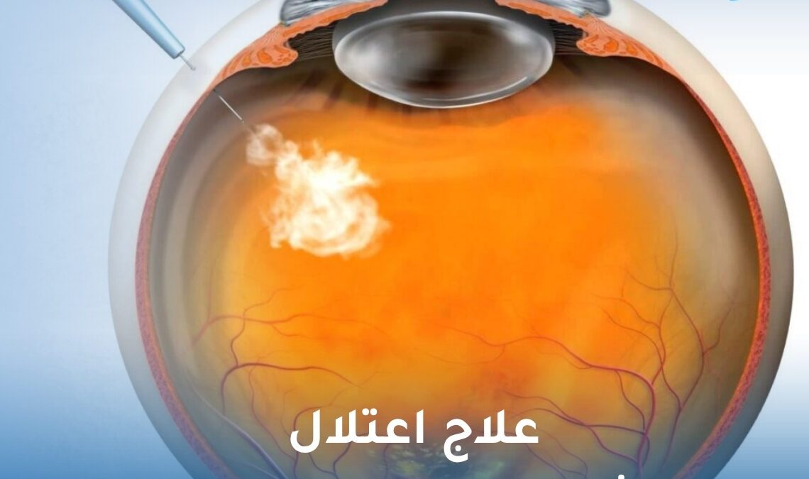 علاج اعتلال الشبكية السكري بالحقن
