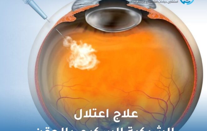 علاج اعتلال الشبكية السكري بالحقن