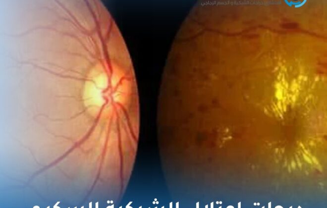 درجات اعتلال الشبكية السكري