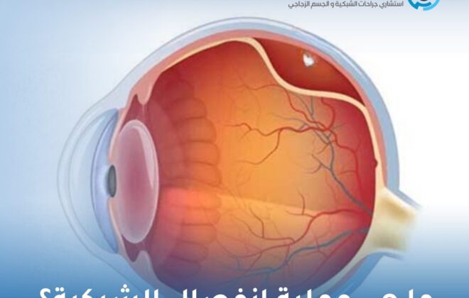 ما هي عملية انفصال الشبكية