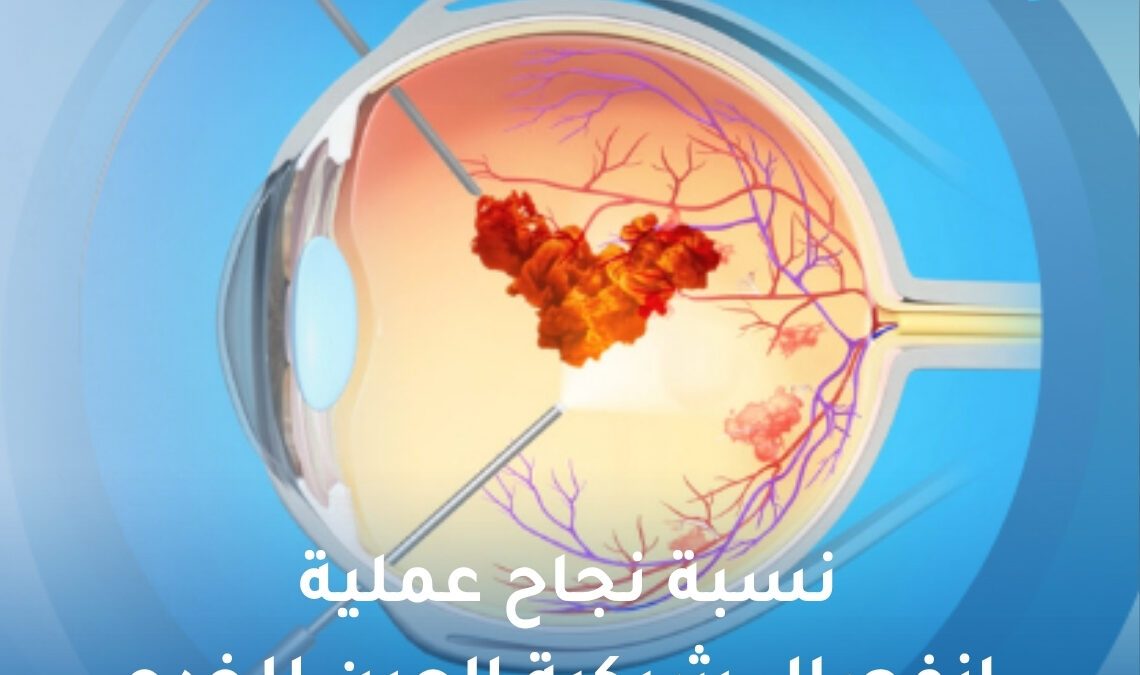نسبة نجاح عملية انفصال شبكية العين للخدج