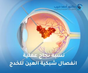 نسبة نجاح عملية انفصال شبكية العين للخدج