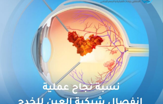 نسبة نجاح عملية انفصال شبكية العين للخدج
