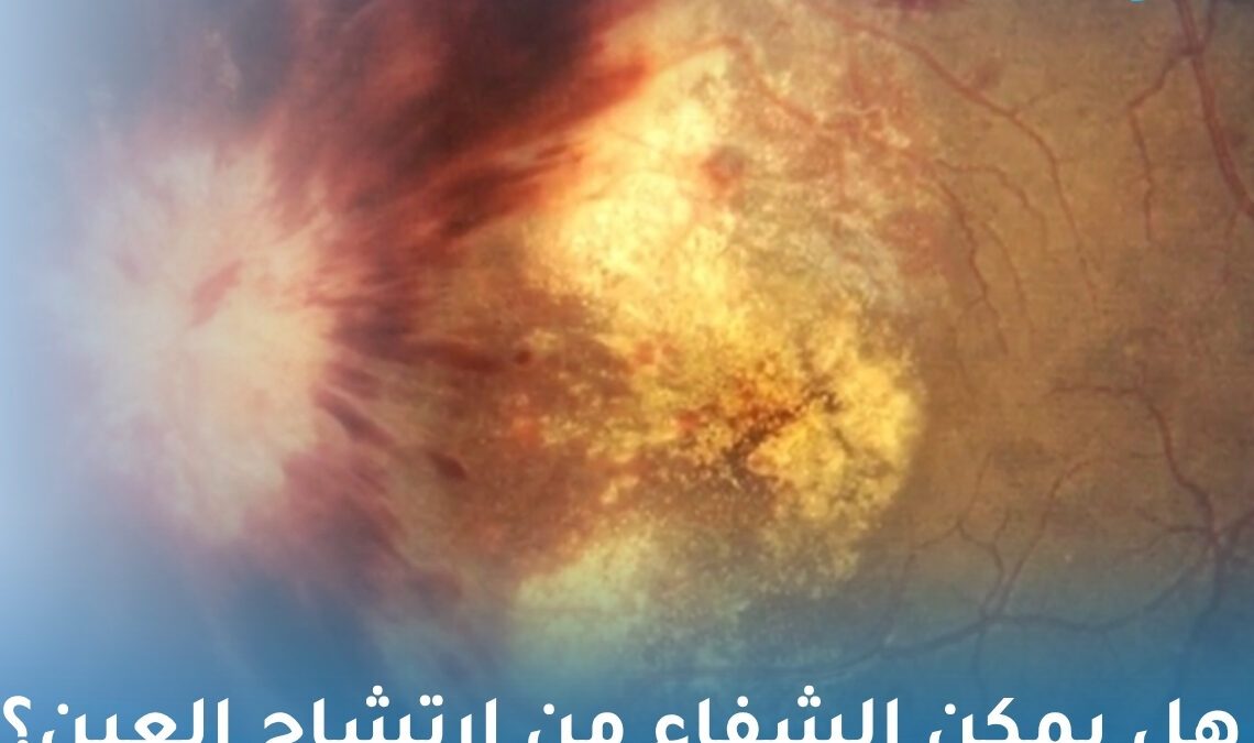 هل يمكن الشفاء من ارتشاح العين