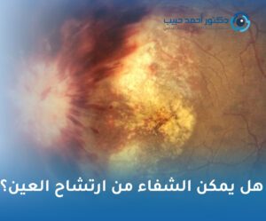 هل يمكن الشفاء من ارتشاح العين