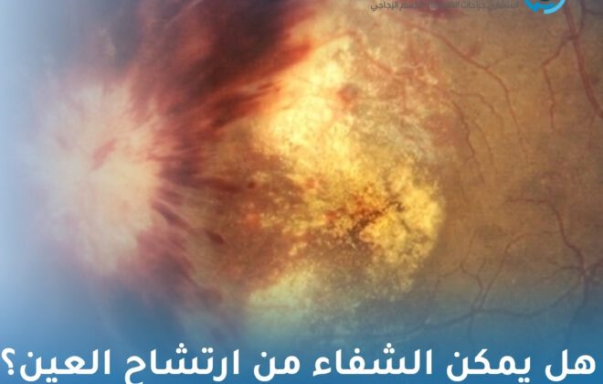 هل يمكن الشفاء من ارتشاح العين