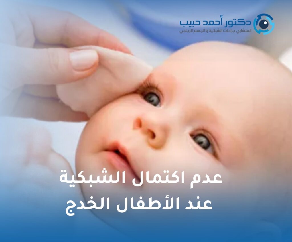 عدم اكتمال الشبكية عند الأطفال الخدج