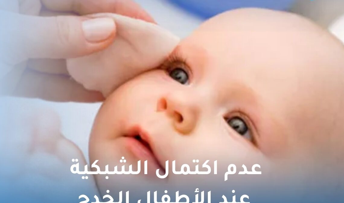 عدم اكتمال الشبكية عند الأطفال الخدج