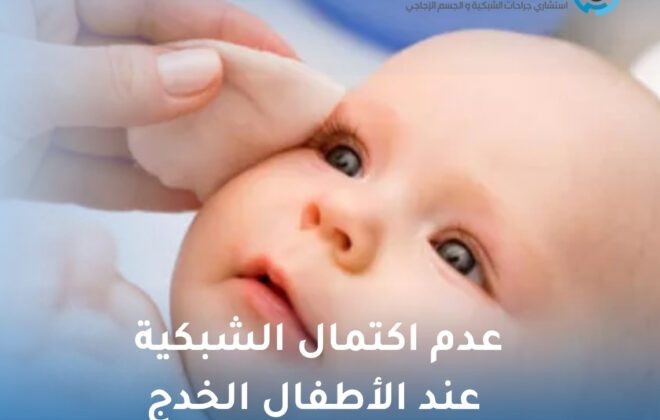 عدم اكتمال الشبكية عند الأطفال الخدج