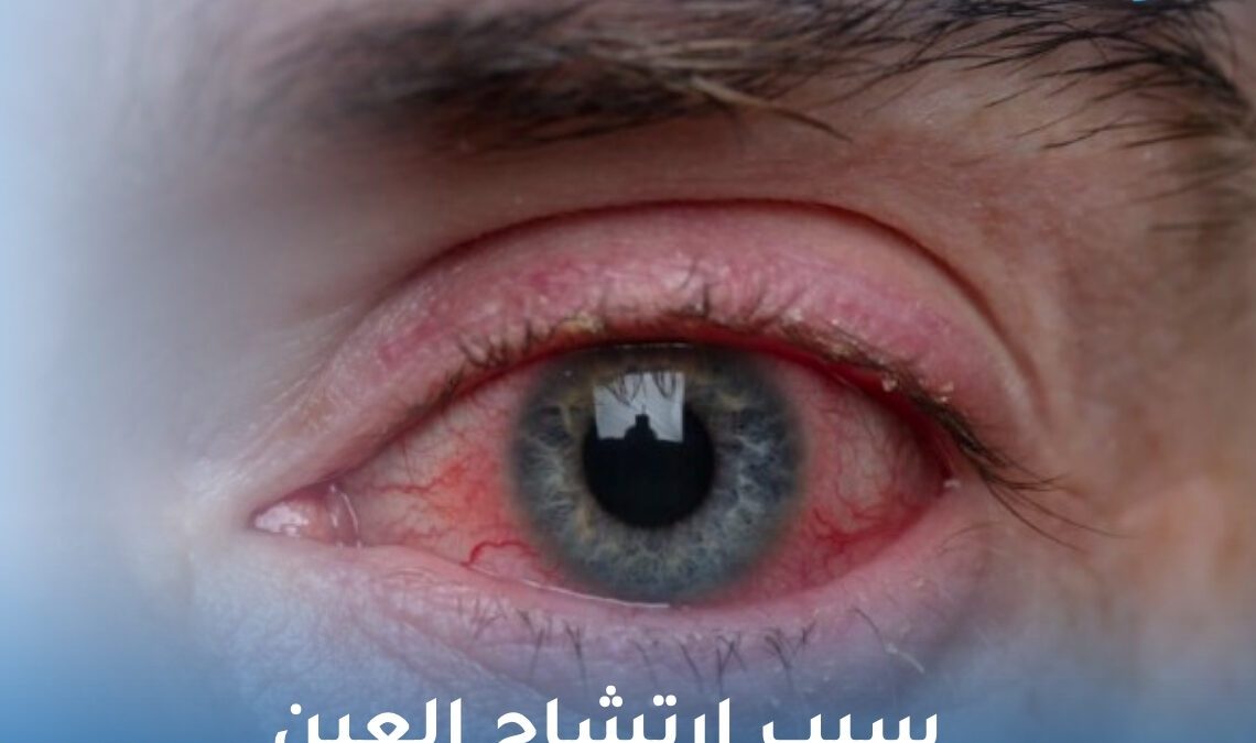 سبب ارتشاح العين