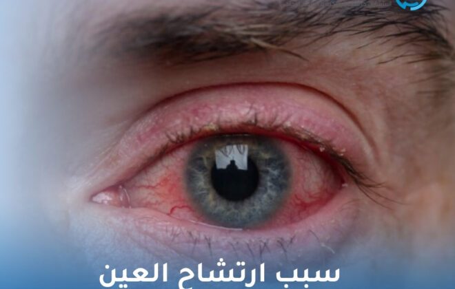 سبب ارتشاح العين