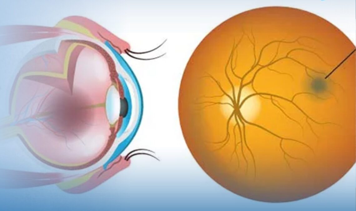 علاج ثقب مركز الابصار