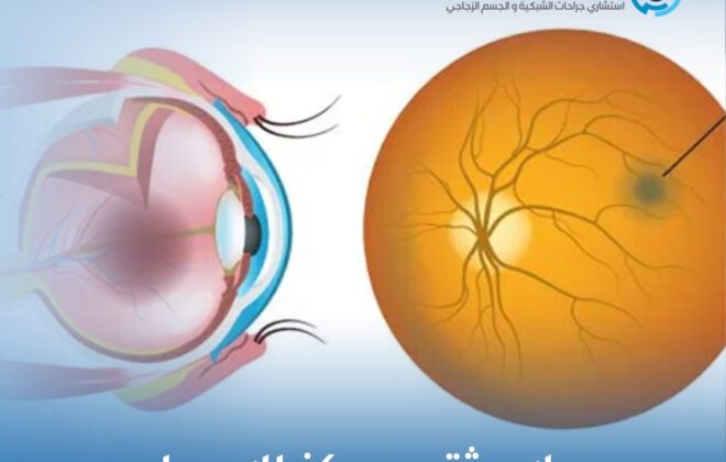 علاج ثقب مركز الابصار