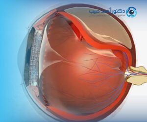 نسبة نجاح عملية انفصال شبكية العين للخدج