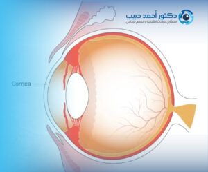 تقوية السائل الزجاجي للعين
