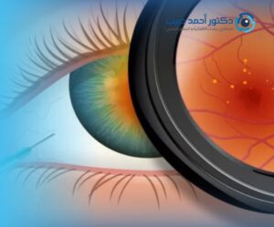 بعد عمليات حقن شبكية العين