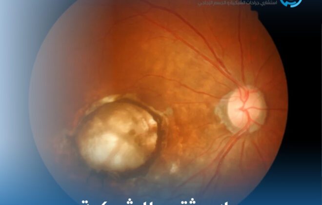 علاج ثقب الشبكية