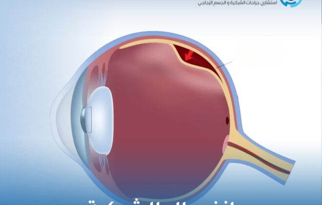 انفصال الشبكية