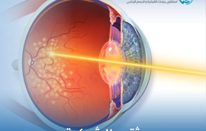 ثقب الشبكية