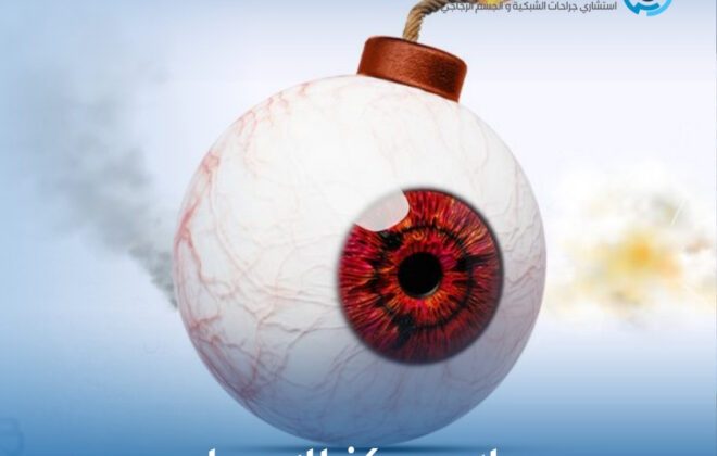 علاج مركز الإبصار