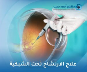 علاج الارتشاح تحت الشبكية