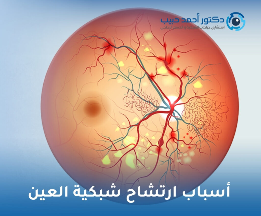 أسباب ارتشاح شبكية العين