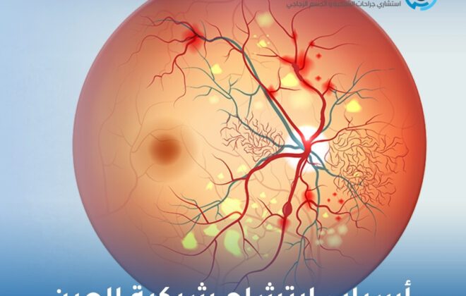أسباب ارتشاح شبكية العين