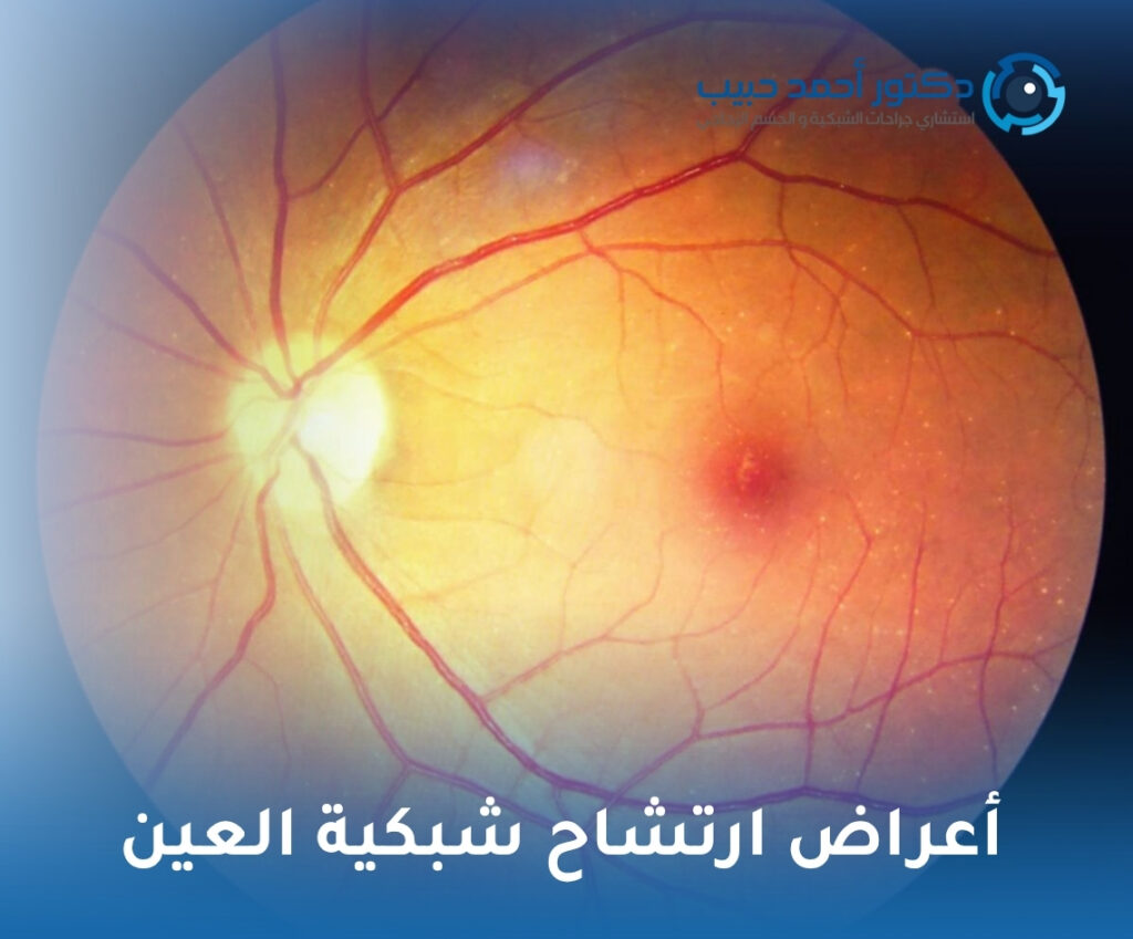 أعراض ارتشاح شبكية العين