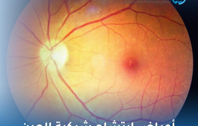 أعراض ارتشاح شبكية العين