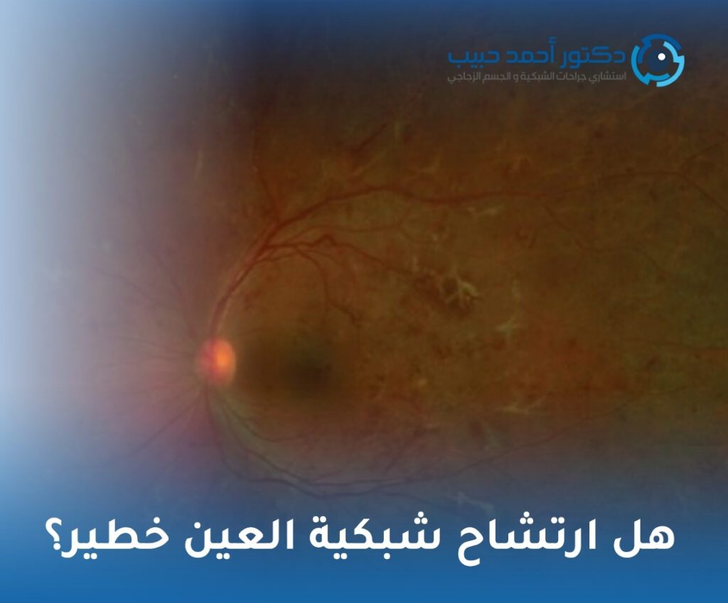هل ارتشاح شبكية العين خطير